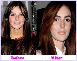 Ali Lohan Plastic Surgery Celeb Cosmetic Surgery Plastic Surgery Ali Lohan Cosmetic Surgery