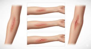 Image result for Skin Tear