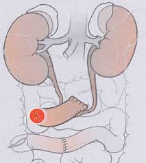 The procedure carries some risks, including bowel. Harnblasenkarzinom Leben Nach Zystektomie Mit Ileumconduit Und Ersatzblase Springerlink