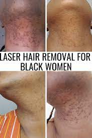 If you are planning on undergoing laser hair removal, you should limit plucking, waxing, and electrolysis for six weeks before treatment. Pin On Healthy Skin Tips