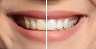 If you are ready to get the white and sparkling smile you've always been dreaming of… keep on reading because you are about to discover the best teeth whitening method. Teeth Whitening Guest Dentistry