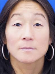 Asian Crease Creation 3079