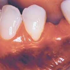 Pdf Retalho Posicionado Apical Modificado E Retalho Posicionado Coronario Combinacao De Tecnicas Cirurgicas Para Tratamento De Recessao Radicular