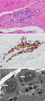 Working with electrical installation makes me very nervous! Lymphocyte Involvement In Nivolumab Induced Autoimmune Myositis Pathology
