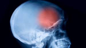 Te Palpita O Truena La Cabeza Seudotumor Cerebral Conoce Todos Los Sintomas