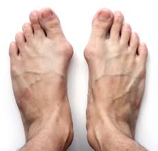 Bumps on gums mainly appear as hard little lumps with pain or no pain. Are Happy Feet Possible With Bunions Fighting Arts Health Lab