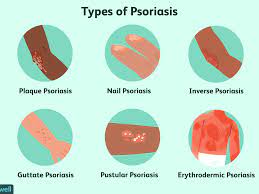 How Psoriasis Is Treated