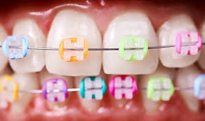What The Color Of Your Rubber Bands Say About You Simply Orthodontics
