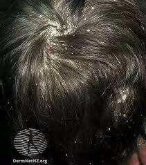 Image result for lice vs dandruff