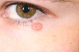 Symptoms of basal cell carcinoma. Basal Cell Carcinoma Dermatology Advisor