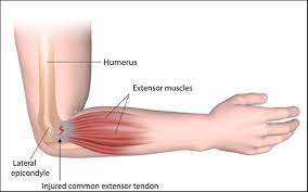The pain associated with tennis elbow may radiate from the outside of your elbow into your forearm and wrist. The Osteopaths Of Heidelberg And Blackburn Melbourne Osteopathy I Don T Play Tennis So How Did I Get Tennis Elbow The Osteopaths Of Heidelberg And Blackburn Melbourne Osteopathy