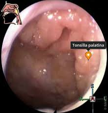 Image result for tonsilla palatina