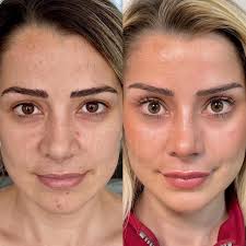 Fox Eye Temporal Lift Fully Healed