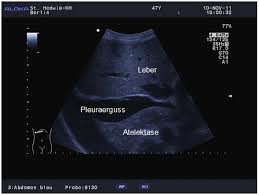 Zusätzlich bei sekundärem spontanpneumothorax oder als alternative aufnahmemethode bei bettlägrigen patienten; Anwendung Des Ultraschalls Am Brustkorb Degum