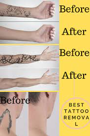 Pin On Best Tattoo Removal Creams 2020
