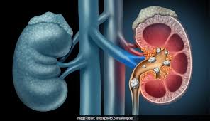Maybe you would like to learn more about one of these? Got Kidney Stone Try Apple Cider Vinegar Here S How It Works Know The Right Method To Use