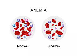 Image result for Anemia