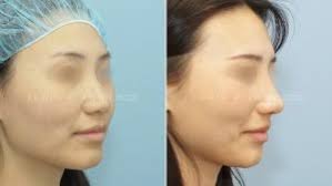 Scarless Breast Augmentation and Endoscopic Breast Augmentation in Beverly  Hills and Los Angeles