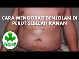 Cara Mengobati Benjolan Di Perut Sebelah Kanan Youtube