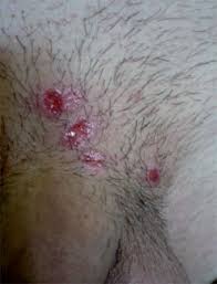 Lesen sie alles wichtige über syphilis! Syphilis Lues
