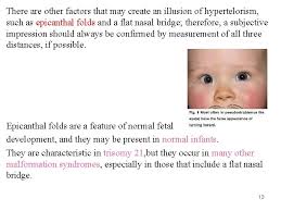 Epicanthal folds are folds in the inner corner of the eye secondary to a flat mid face or a smaller than usual nasal bone. Physical Examination Of Newborn By Dr Behzad Barekatain