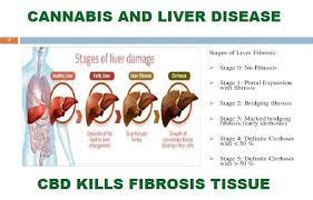 Cannabis Concentrates For Liver Disease