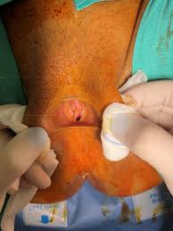 Image result for Labial Fusion