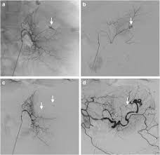 The intentional blockage of an artery with an object (as a balloon inserted by a catheter) to control or prevent hemorrhaging. Ten Year Experience With Arterial Embolization For Peptic Ulcer Bleeding N Butyl Cyanoacrylate Glue Versus Other Embolic Agents Springerlink