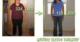 We Have Advice For Anybody Seeking Plastic Surgery Gastric Sleeve Surgery In Tijuana Mexico Get Rid Off W Sleeve Surgery Gastric Sleeve Surgery Gastric Sleeve