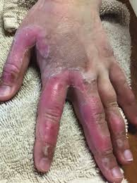 This fungal disease usually affects the skin. Collection Of Conditions Affecting The Hands Consultant360