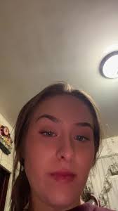 I burnt my forehead with a curling iron