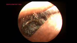 Impacted Ear Wax Three Year Old Child Removal By A Specalist Impacted Ear Wax Impacted Ear Wax Removal Ear Wax