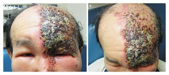 Image result for herpes zoster