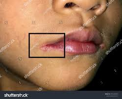 Image result for Angular Stomatitis