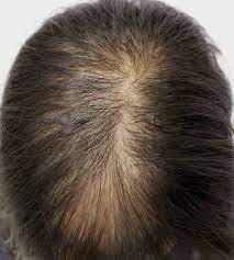 Scalp folliculitis and hair loss scalp folliculitis, or hair folliculitis, is common among both men and women. Preparing The Mind To Recognize The Many Forms Of Hair Loss Donovan Hair Clinic
