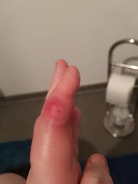 Image result for phlegmon of hand)