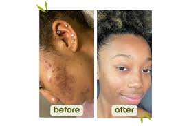 Struggling with Old Acne Scars? Let's Talk.