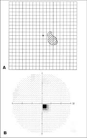 A Amsler Chart And B Humphreys Static Perimetry Showing A