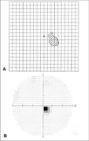 a amsler chart and b humphreys static perimetry showing a