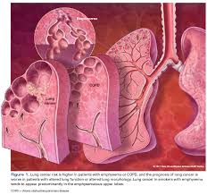 A recent scan for some clavicle swelling found 3 bone lesions and a lung nodule. Understanding The Links Between Lung Cancer Copd And Emphysema A Key To More Effective Treatment And Screening