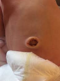 Wonder how to care for your newborn's umbilical cord stump? Gross Warning Newborn Belly Button Concern Babycenter