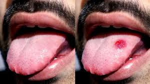 Image result for cancer of tongue