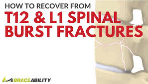 Боль в низу живота, пояснице. How Can I Treat A T12 Or L1 Thoracic Spinal Burst Fracture