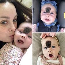 Baby girl's transformation after hemangioma treatment