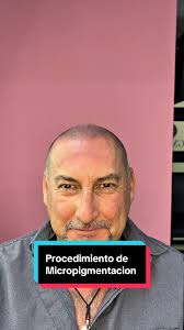 Micropigmentación Capilar: La Solución para Calvos