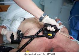 Image result for Synchronized Cardioversion