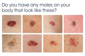 Melanoma can grow very quickly. Thc Cbd May Decrease Viability Of Melanoma Cells