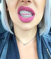 Braces Braceface Metalbraces Girlswithbraces Braces Girls Cute Braces Dental Braces