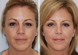 طريقة جراحة شد الجفون مجلة رجيم