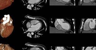 Este malestar o dolor puede sentirse como un dolor constrictivo, presión, sensación de plenitud u opresión en el pecho que dura más de unos pocos minutos. Enfarte Do Miocardio Cuf